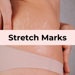 Stretch Marks Concern